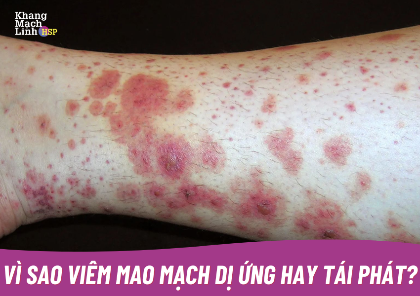 Vì sao viêm mao mạch dị ứng hay tái phát? Cách hạn chế tái phát hiệu quả