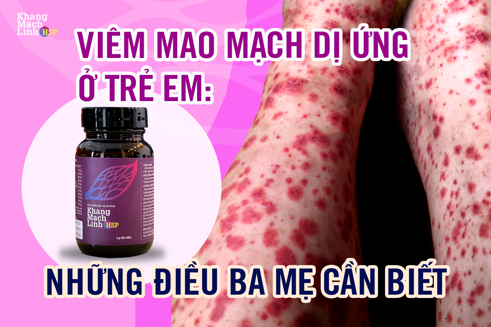 Viêm mao mạch dị ứng ở trẻ em: Những điều ba mẹ cần biết