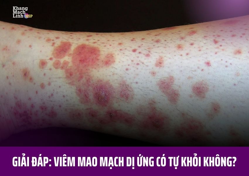 Viêm mao mạch dị ứng có tự khỏi không? Sự thật bạn cần biết trước khi quá muộn