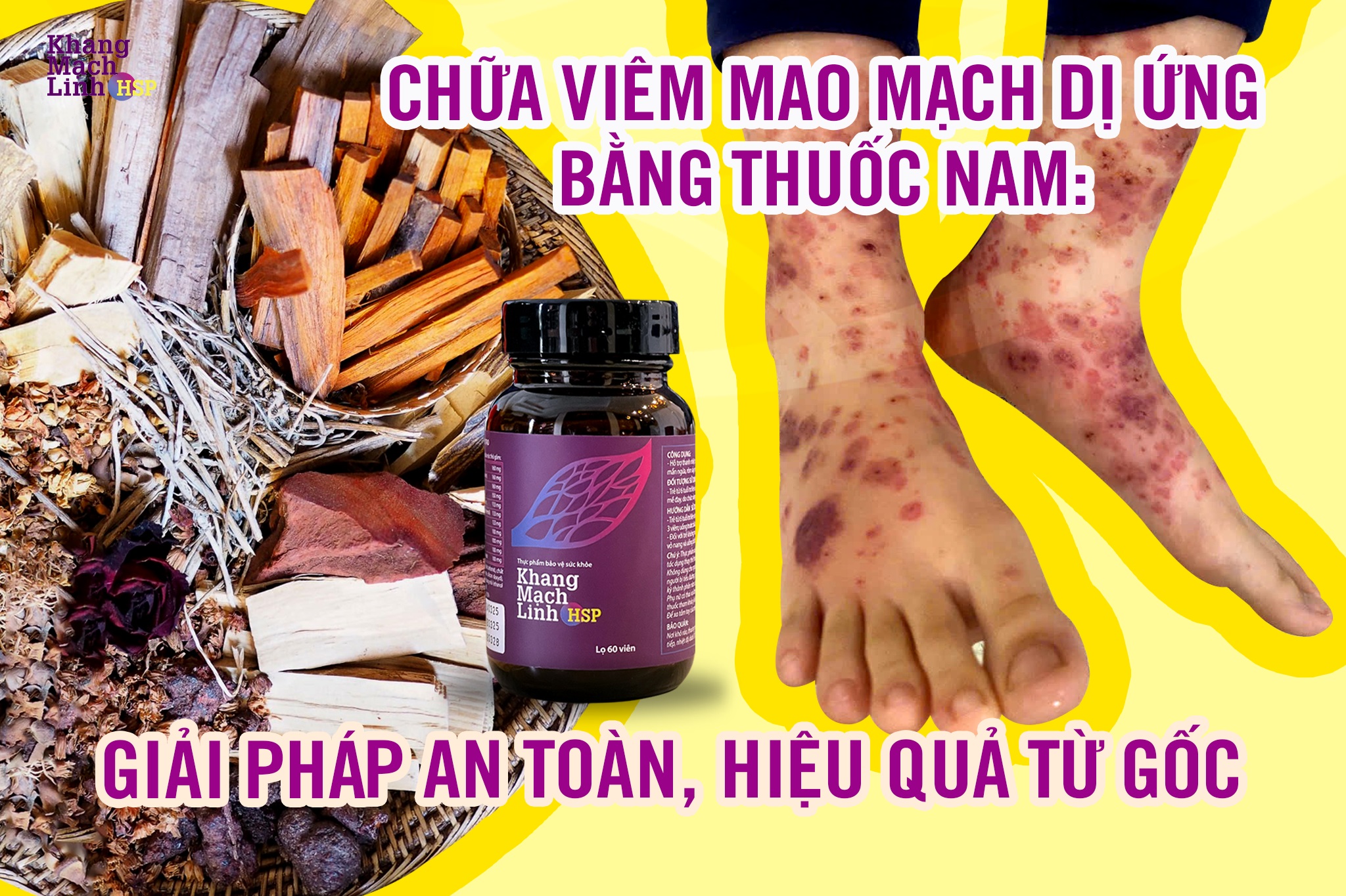 Chữa viêm mao mạch dị ứng bằng thuốc nam: Giải pháp an toàn, hiệu quả từ gốc